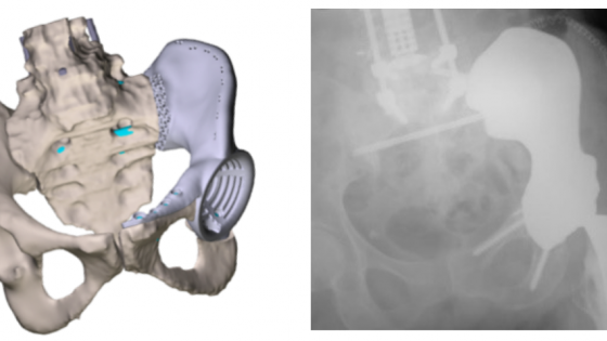 graphic of human pelvis adjacent to X-ray of matching hemipelvis titanium implant