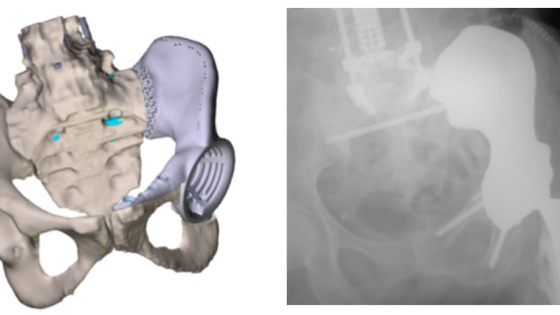 Developing Materials for Medical Implants to Repair Human Bone and for Other Applications